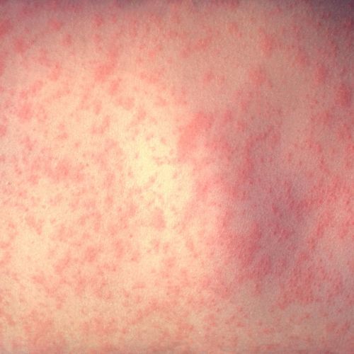 Miami high school reports first student case of measles for year