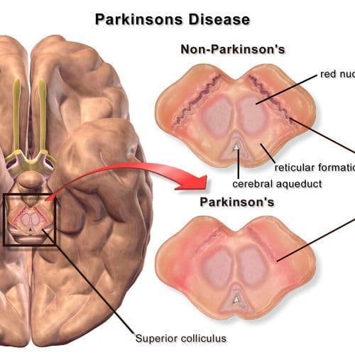 Testimony. She Heals Parkinson's Disease and Makes John Paul II a Saint.