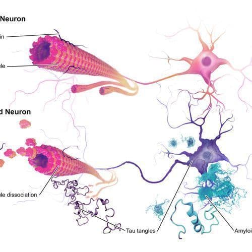 Newborns and Alzheimer's Patients Have Elevated Blood Levels of Phosphorylated Tau