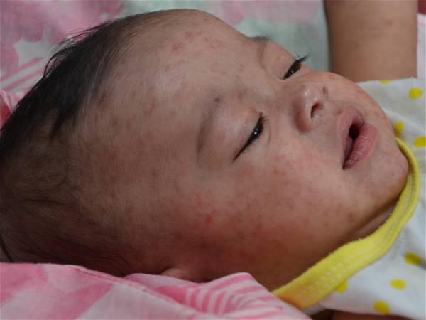 4 things you should know about measles amid an uptick in cases
