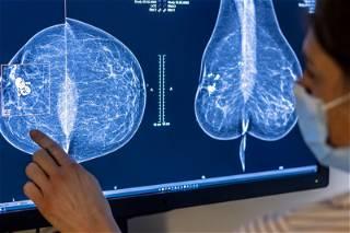Google Health licenses its AI breast cancer screening tool